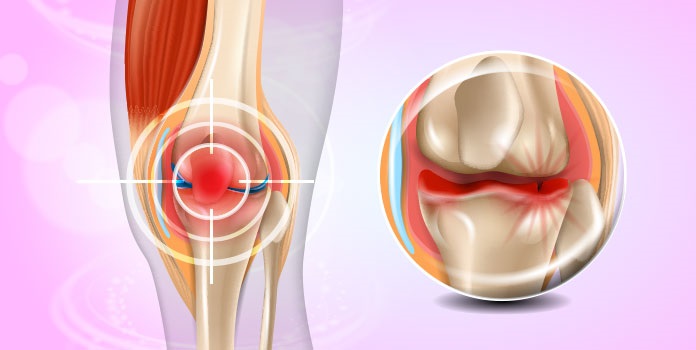 What are the symptoms of knee pain